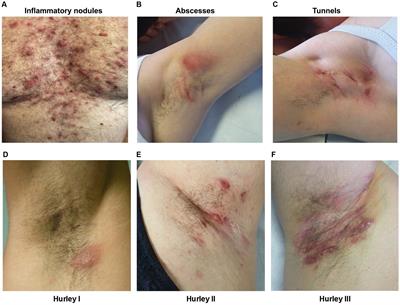 Biologic drugs in hidradenitis suppurativa: what does the GP have to know? A narrative review